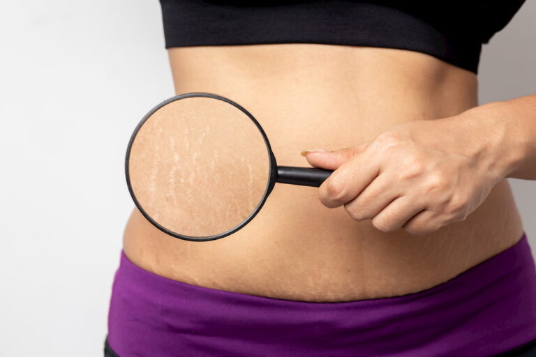 Do Stretch Mark Treatments Really Work? Here’s What You Need to Know